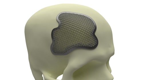 Generative Design Example Using Lattice Skull Bone Plate
